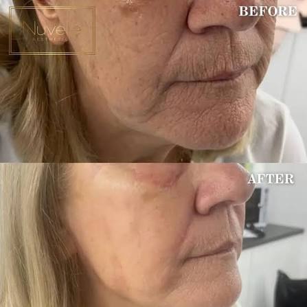 HYARON-SKIN BOOSTER |NON-CROSSLINKED HA,25MG/2.5ML